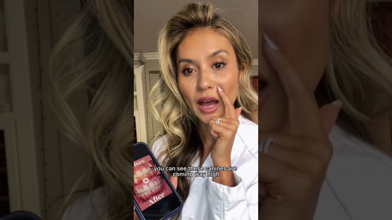 Signs you need braces part 2!