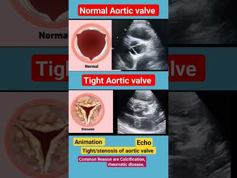 Normal and Tight Aortic valve l  l Animation #echo #shorts