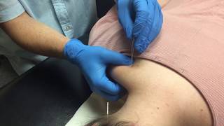Functional Dry Needling and Headaches