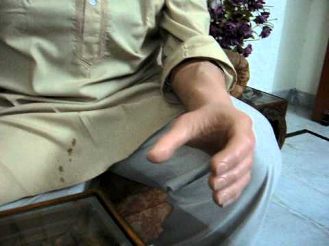 Bilateral artificial arms