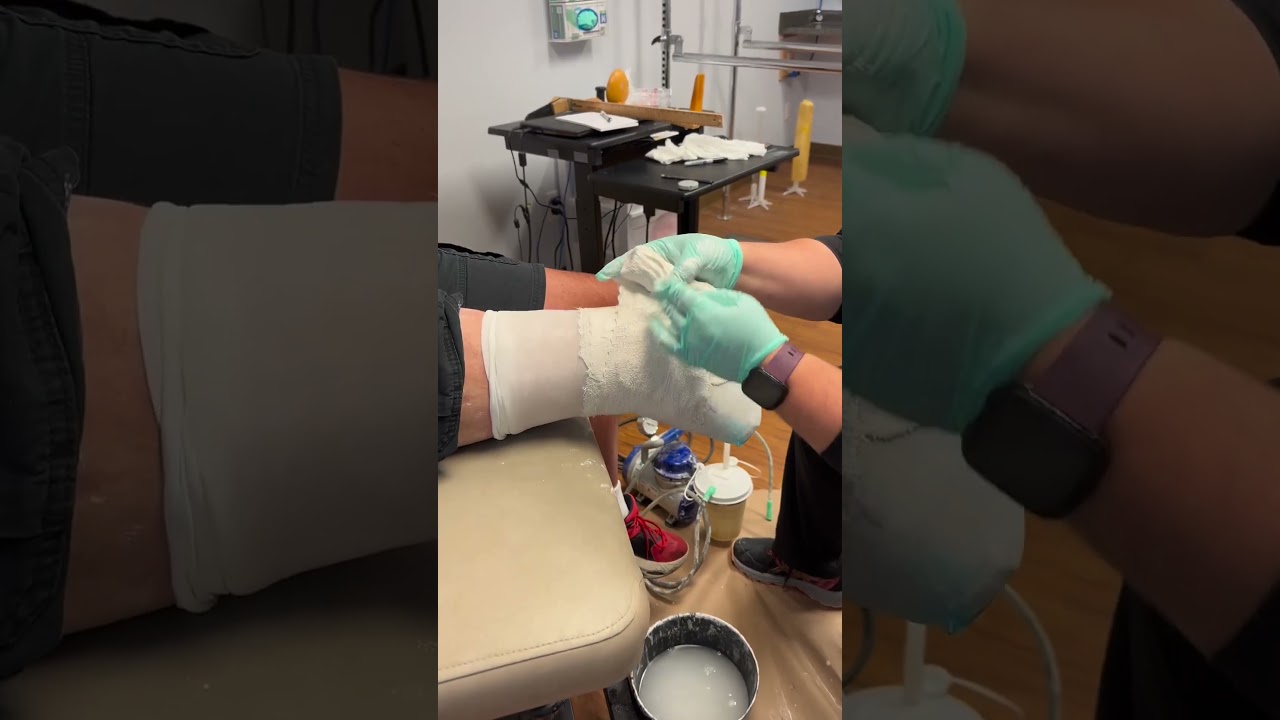 How It's Made: Prosthetic Fabrication Process - Casting