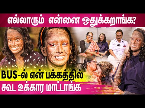 Chinchu-வின் உருவம் ஏன் இப்படி ஆனது? | Chinchu Antony | Lamellar Ichthyosis