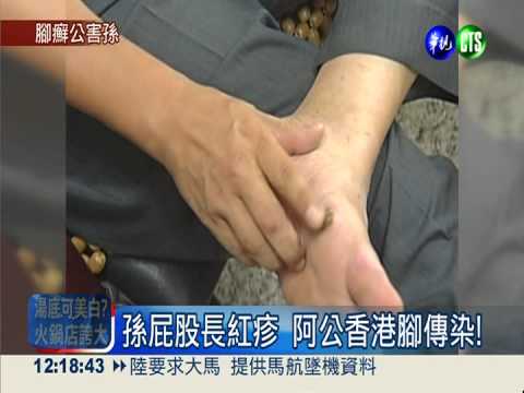 爺摳香港腳傳染 孫屁股長"股癬"