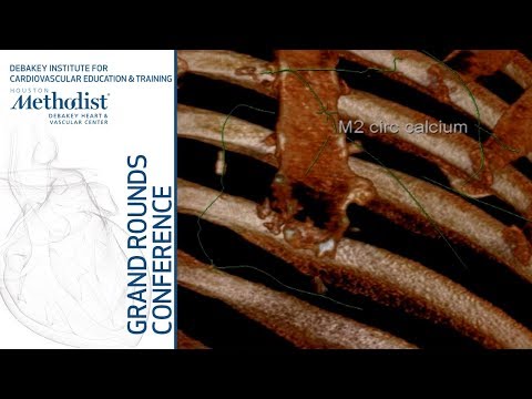 Reversing “Renalism” in Revascularization (Ziad A. Ali, MD) November 29, 2018