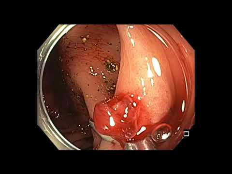 Colonoscopy: Bleeding - Postpolypectomy Bleeding Control