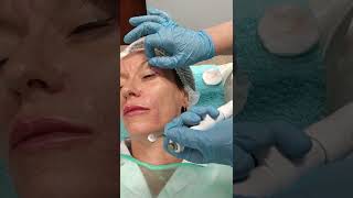 Rellenos con Acido hialuronico zona de patas de gallo