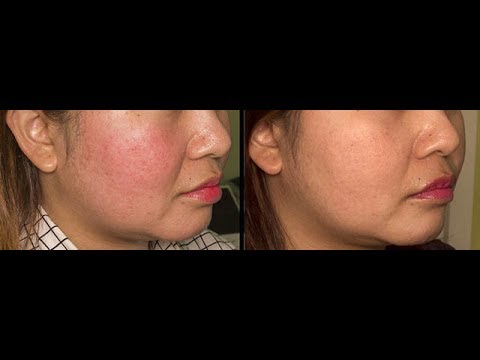 Bagaimana mengambil jahe untuk resep penurunan berat badan Kehilangan berat badan pada kubis