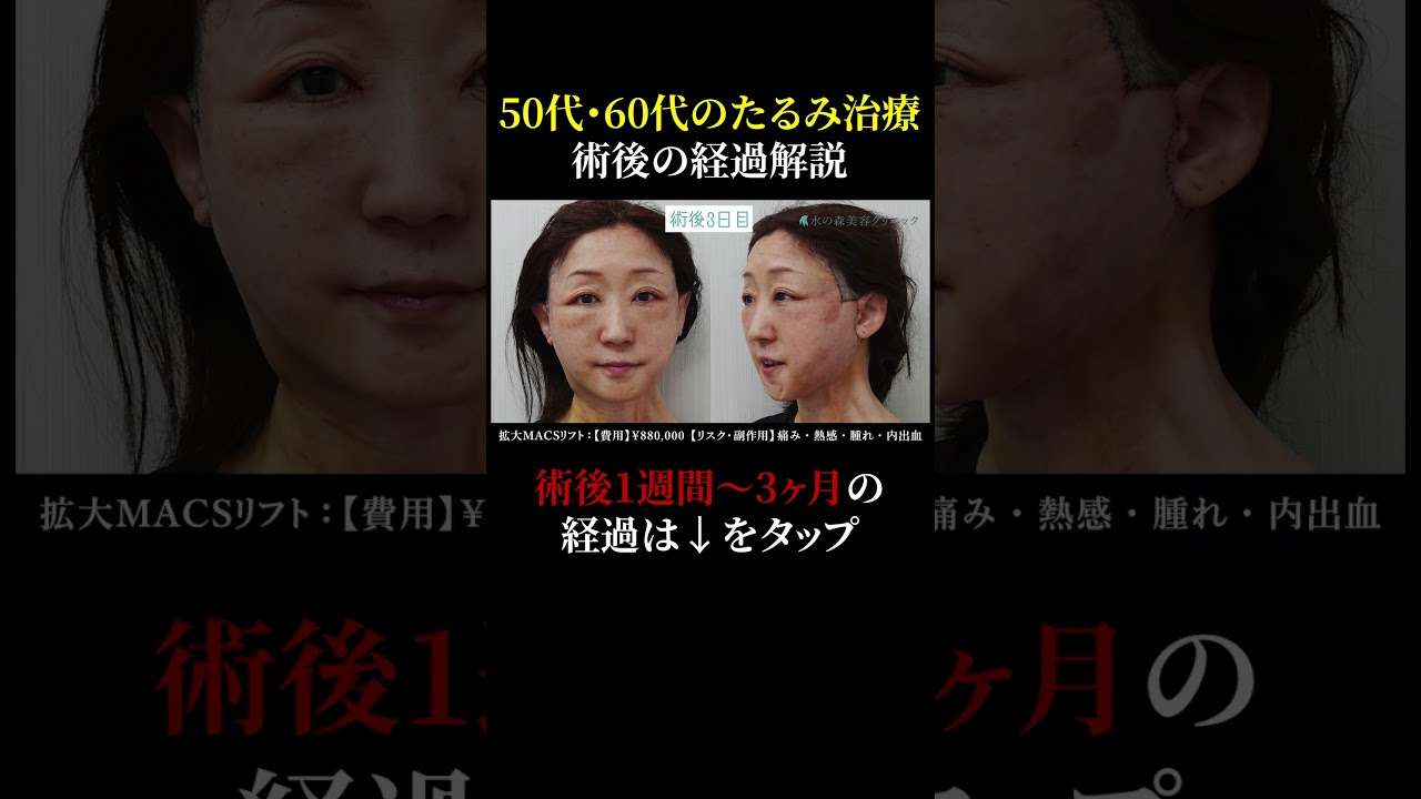 【症例公開】最新たるみ治療、拡大MACSリフトのダウンタイム全て見せます！