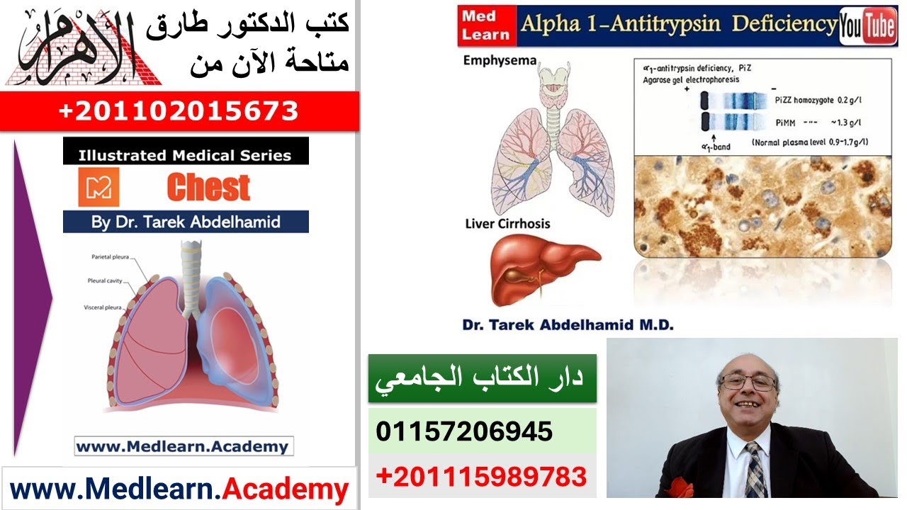 α-1 antitrypsin deficiency   #cme #internal_medicine #medical #usmle #محاضرات_باطنة