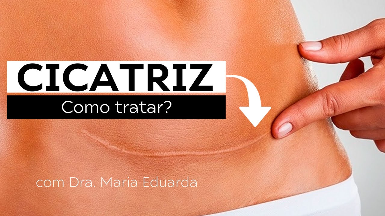 COMO MELHORAR UMA CICATRIZ
