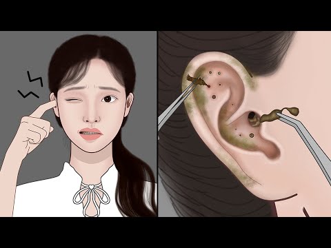 Itchy & Smelly Ear Stone Removal! Digging Out Super Big Earwax | ASMR Animation | Meng's Stop Motion