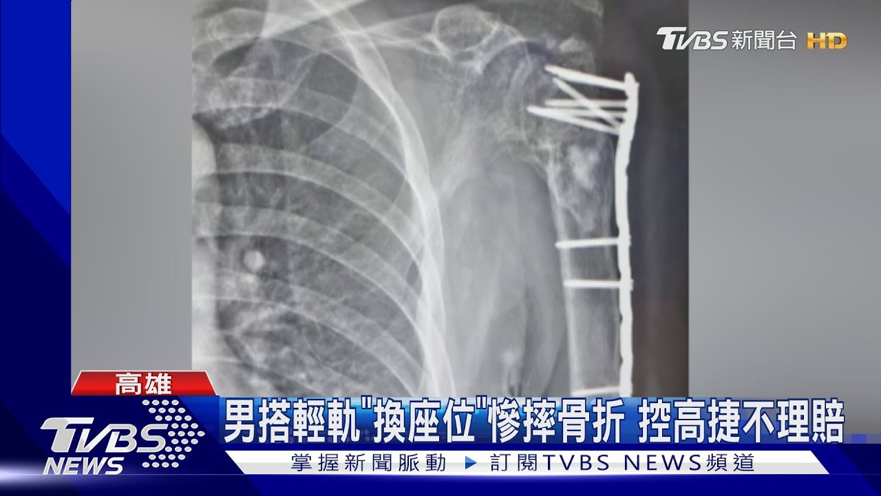 6旬翁搭輕軌慘摔 骨折開刀高捷「不理賠」原因曝