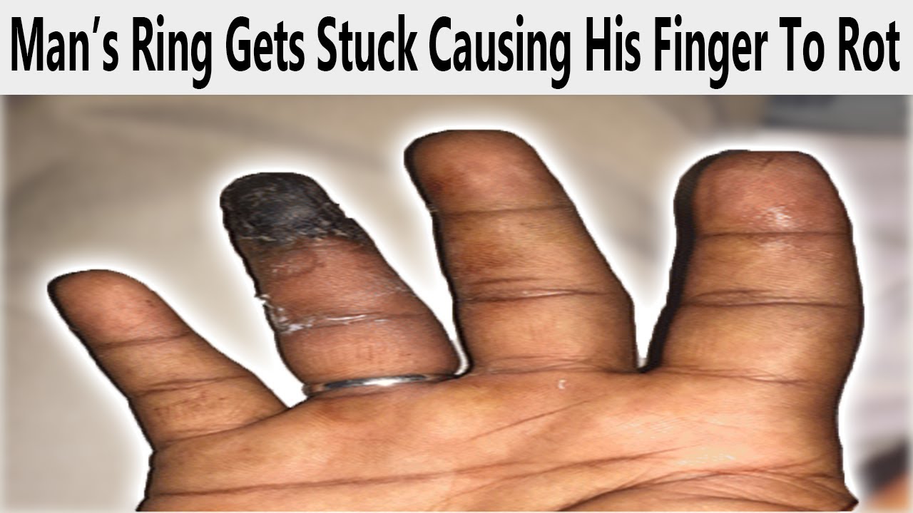 r/WellThatSucks | It Rotted Off