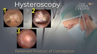 Retained Product of Conception