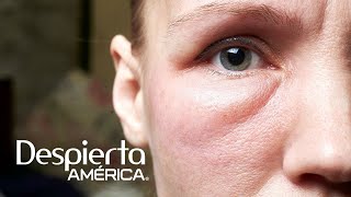 ¿Sufres de hinchazón en la cara Estas podrían ser las posibles causas | Dr. Juan