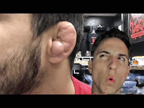 DRAINING MY FRIENDS CAULIFLOWER EAR (TUTORIAL)