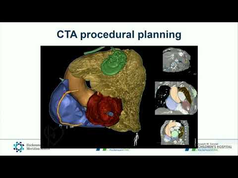 CVI 2019_Thursday 7/18_ Breaking Boundaries with Mitral Valve Therapy_Tilak Pasala, MD