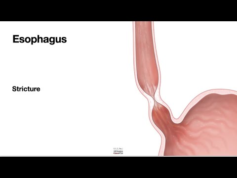 HCC 1475-38a-Stricture Dilation Concepts