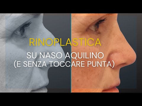 Caso di naso "aquilino": come la rinoplastica migliora il profilo senza toccare la punta