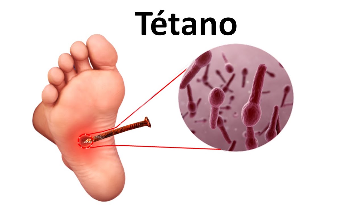 TÉTANO