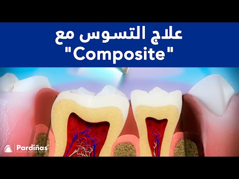 علاج التسوس – Composite restoration ©