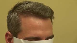 Hair Transplant FUE Surgery Result Receding Hairline 2100 Grafts Dr. Diep www.mhtaclinic.com