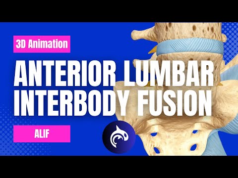 Lumbar Stenosis 3D Animation