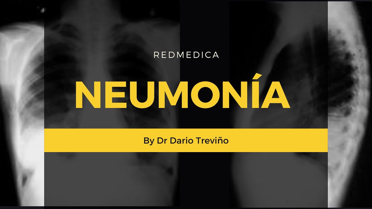 Neumonia (Etiologia, diagnostico y tratamiento) #ENARM