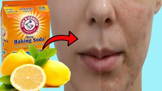 How To Get Rid of Acne Scars & Dark Spots With Baking Soda & Lemon
