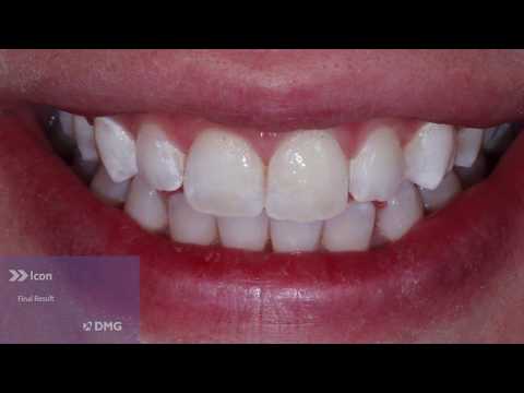 Using Icon to Treat Smooth Surface White Spots