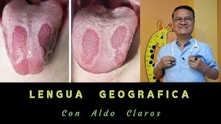 LENGUA GEOGRÁFICA EN NIÑOS