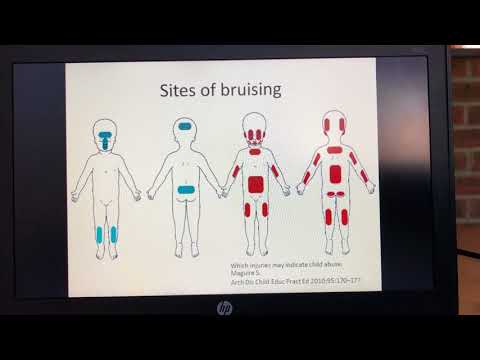 Assessing Bruises in Children’s Safeguarding