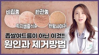 비립종 한관종 피지샘증식증 편평사마귀! 좁쌀여드름이아니라고? 원인부터 확실한 치료방법까지❗