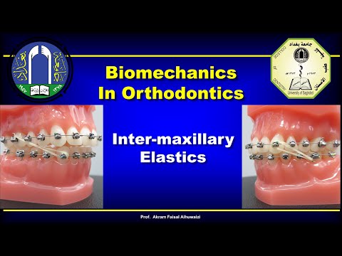 Intermaxillary Elastics in Orthodontics