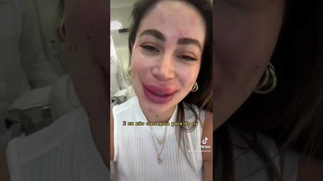 Olha como ficou minha boca depois de remover o preenchimento labial ??