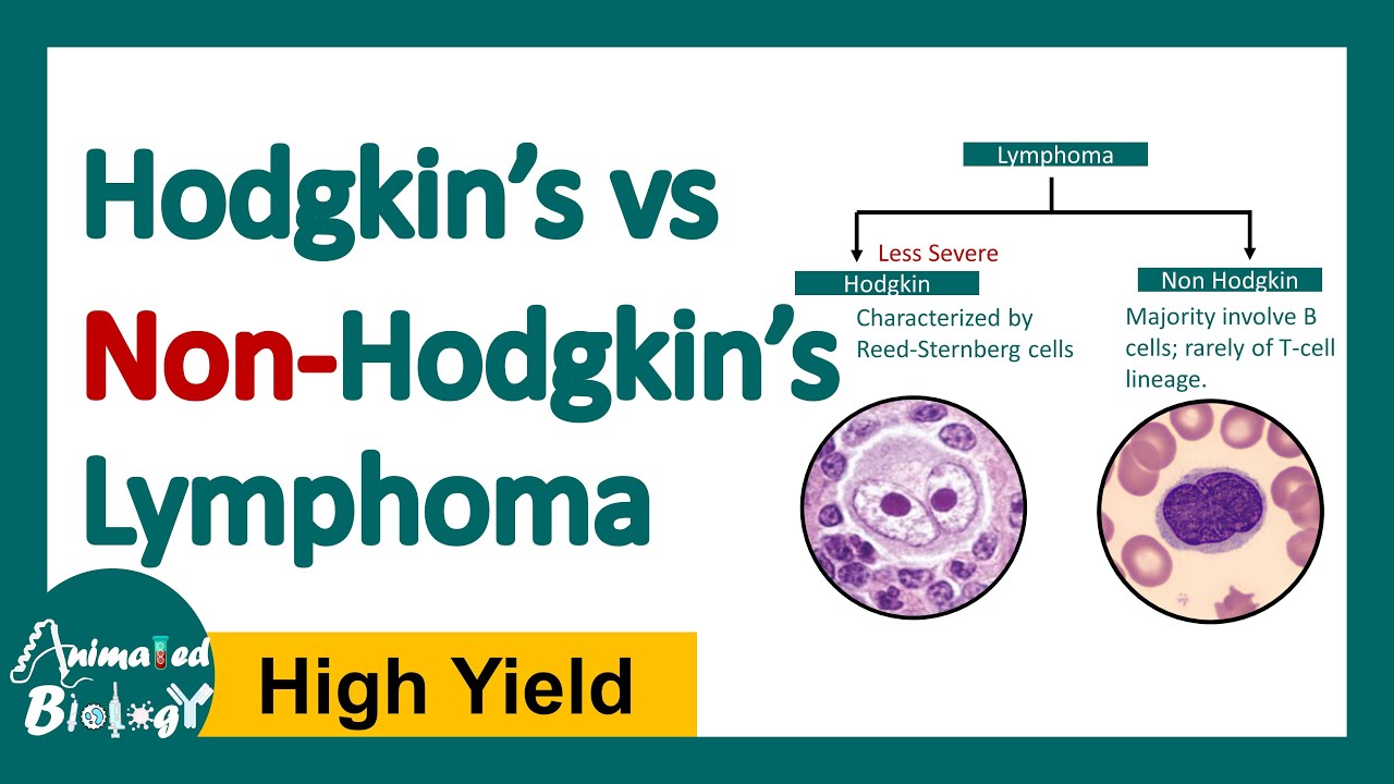 Hodgkin vs Non Hodgkin Lymphoma | Differences between Hodgkin and Non Hodgkin lymphoma