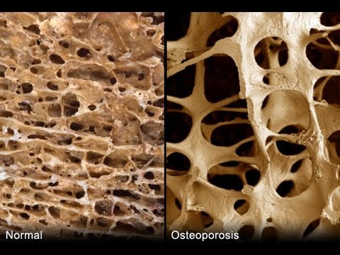 Als Arthritis, Osteochondrose zu behandeln Ob Crunch Knöchel