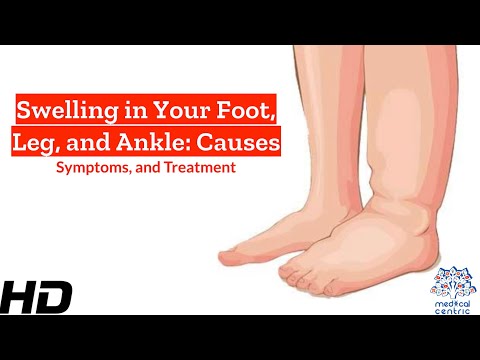 Frozen Shoulder Causes Signs and Symptoms Diagnosis and Treatment