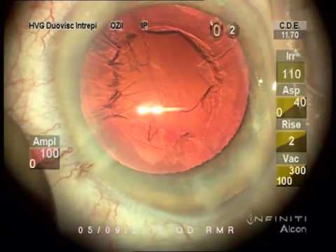 Chirurgie de la cataracte - vidéo didactique