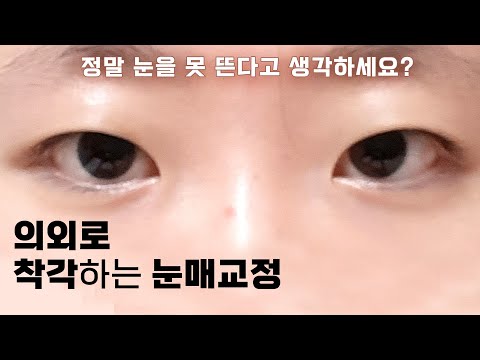 上睑下垂 03