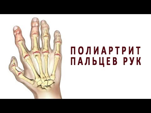 Болит поясница с лева отдает в ногу Грыжа диска в шейном отделе 3 мм