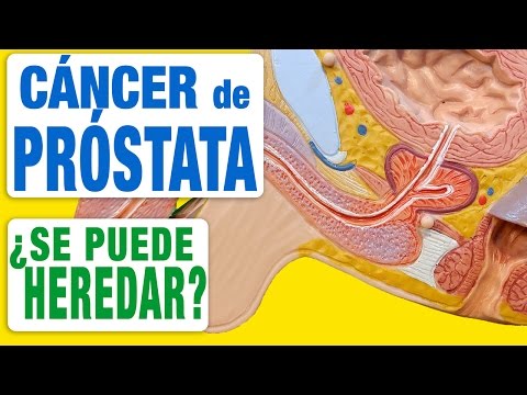 prostata piccola con calcificazioni