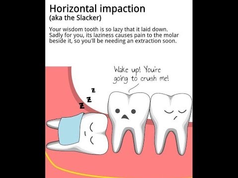 horizontal impacted 3rd molar extraction - without bone removal