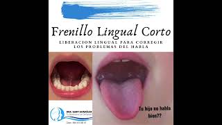 Cirugía Maxilofacial en Saltillo _ Cirugía de Frenillo Lingual Corto