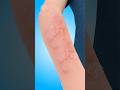 Hives: What Happens Inside Your Body 😮 #shorts #urticaria - Creativelearning3d
