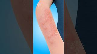 Hives: What Happens Inside Your Body 😮 #shorts #urticaria - Creativelearning3d