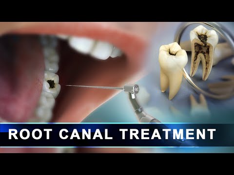 Root Canal Treatment step by step |  Curveia Dental Animation in 3D - Endodontics for tooth decay