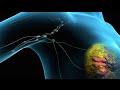 Breast Cancer | Tumor Removal Surgery | Nucleus Health