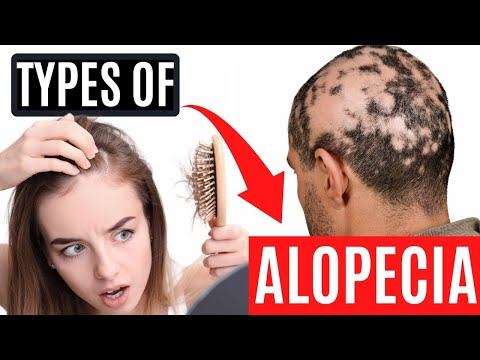 ⚠ Types of ALOPECIA in MEN and WOMEN 👨‍🦲