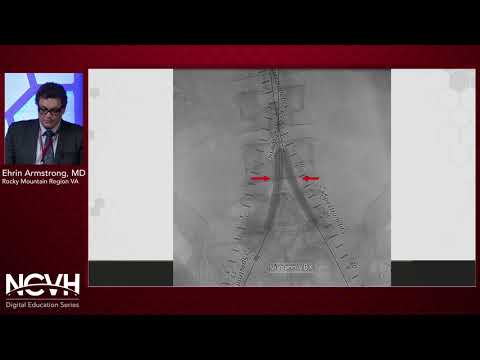 Dr. Ehrin Armstrong, Endovascular Treatment of Advanced Aortoiliac Disease